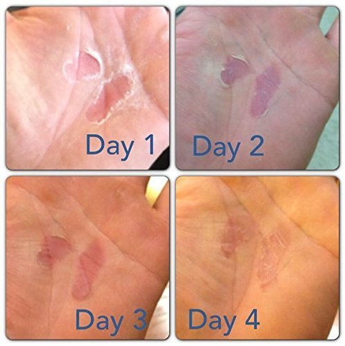 RipFix Hand Repair Cream and Callus Treatment for Cracked or Ripped Hands - 0.3 oz Travel Size Tin - 3 Pack